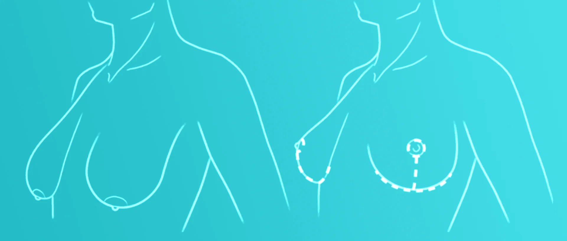 Augmentation Mastopexy