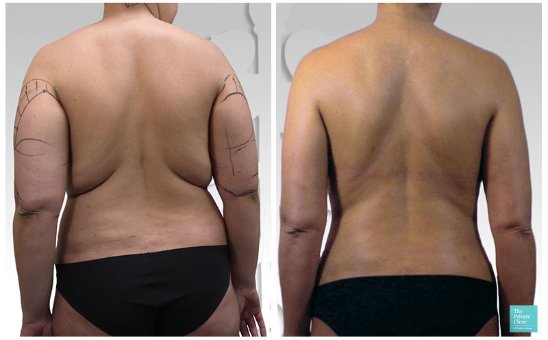 Back Fat Liposuction