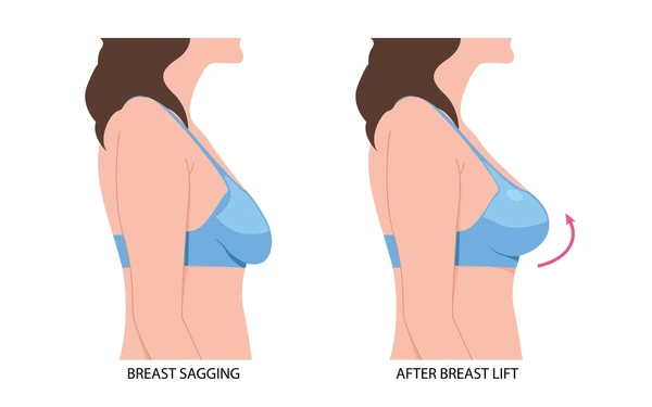Breast Lift Mastopexy