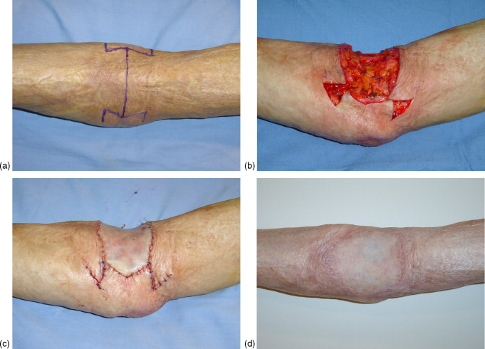 Burn Scar Contracture Release