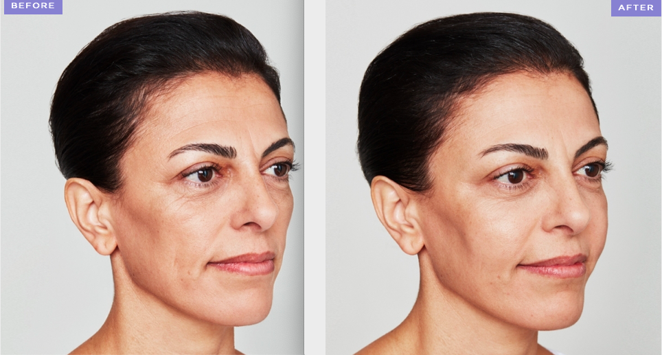 Cheek Augmentation