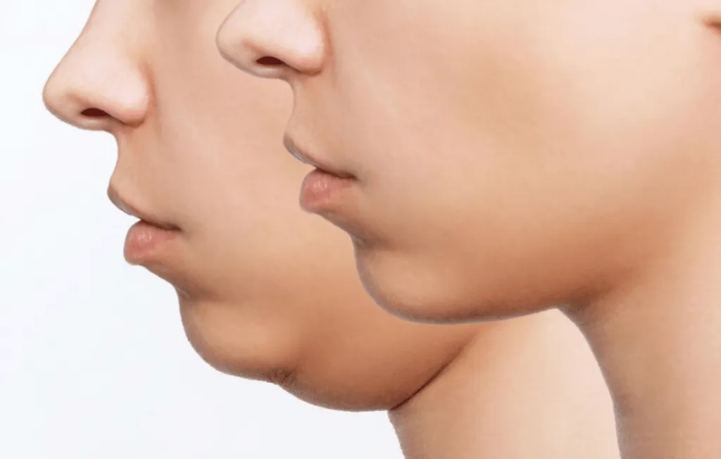 Chin Reduction