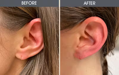 Earlobe Repair