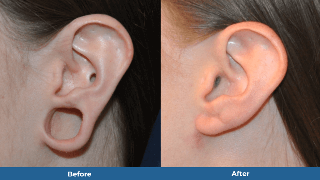 Gauged Ear Correction