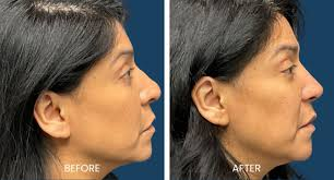 Female Rhinoplasty