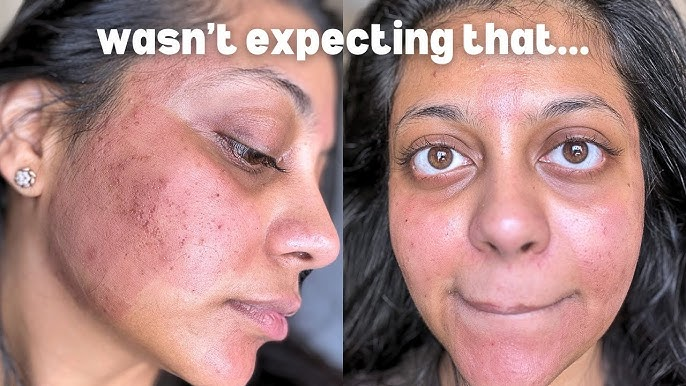 Fractional CO2 Laser