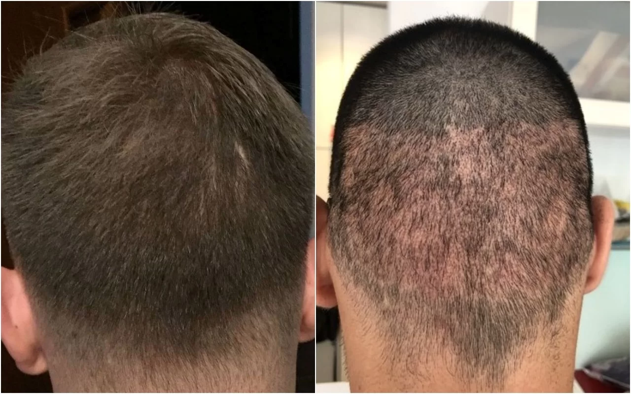FUE Hair Transplant