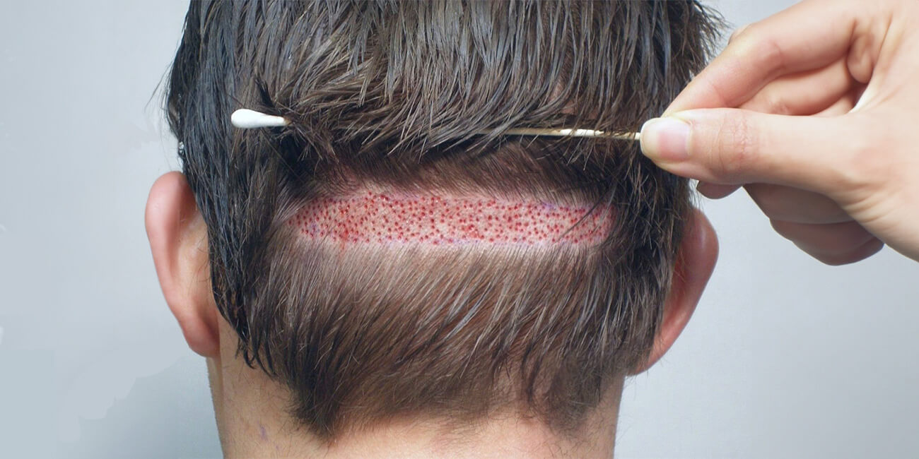 FUT Hair Transplant