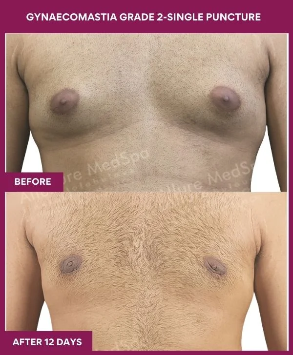 Grade II Gynaecomastia