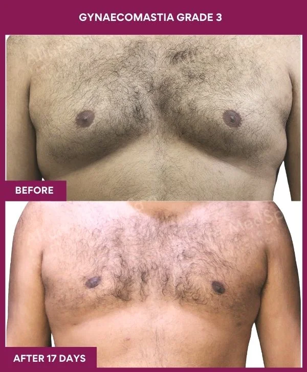 Grade III Gynaecomastia