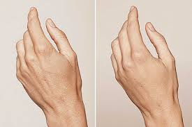 Hand Rejuvenation