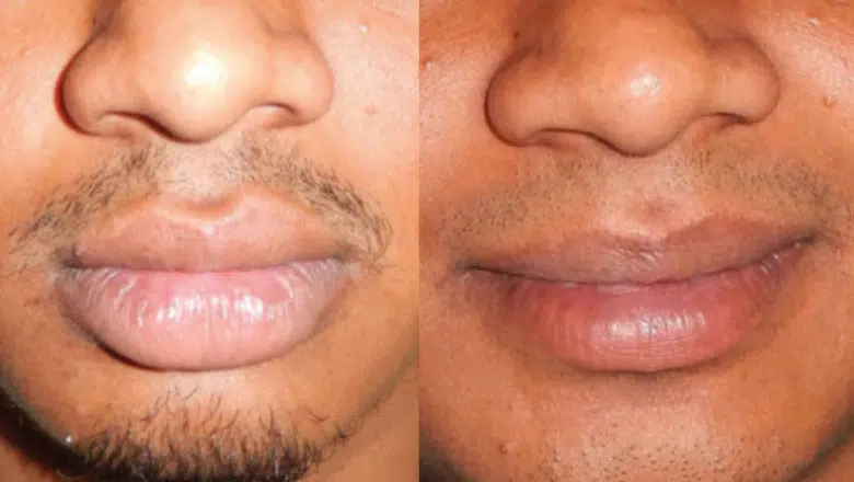 Lip Reduction