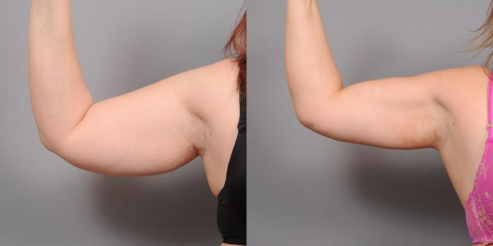 Arm Liposuction