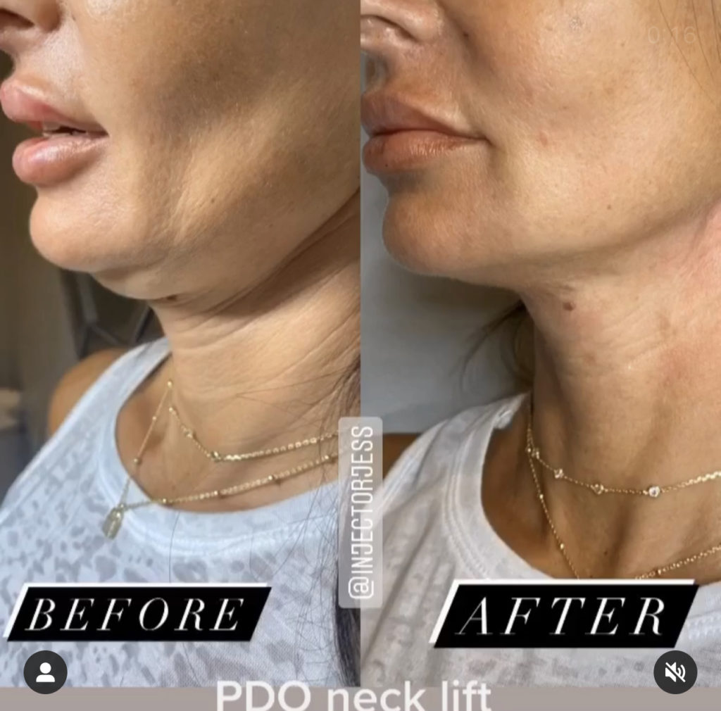 PDO Threads for Neck Rejuvenation