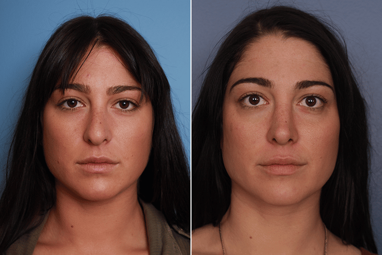 Revision Rhinoplasty