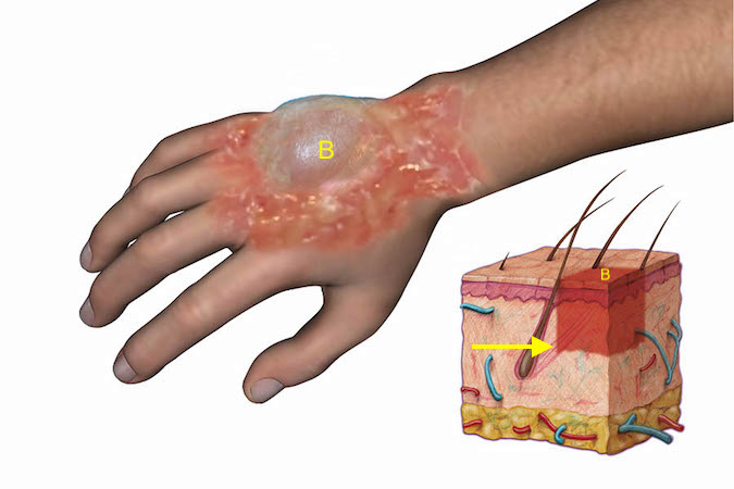 Secondary Burn Deformity Correction