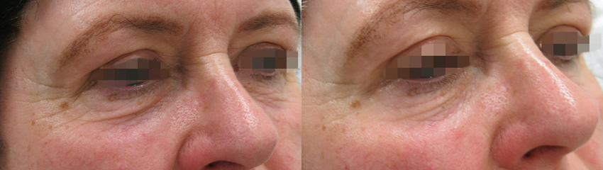 Tear Trough Correction