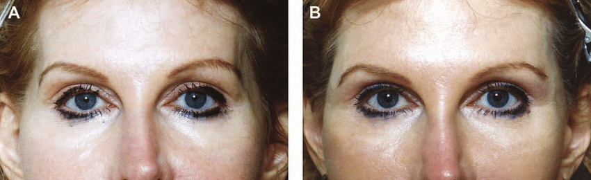 Temporal Volume Restoration