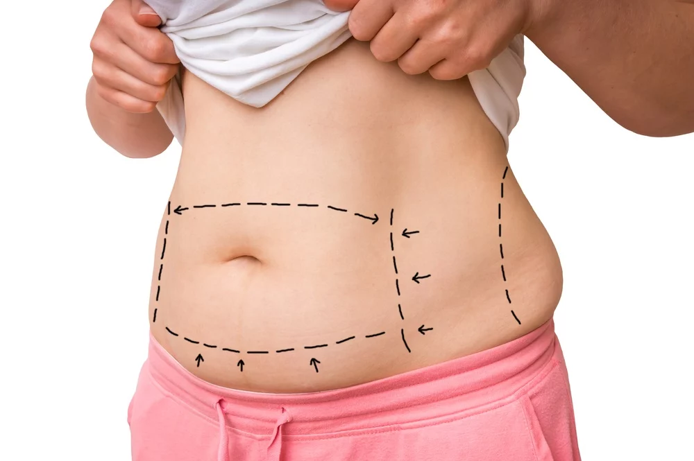 Tummy Tuck Surgery