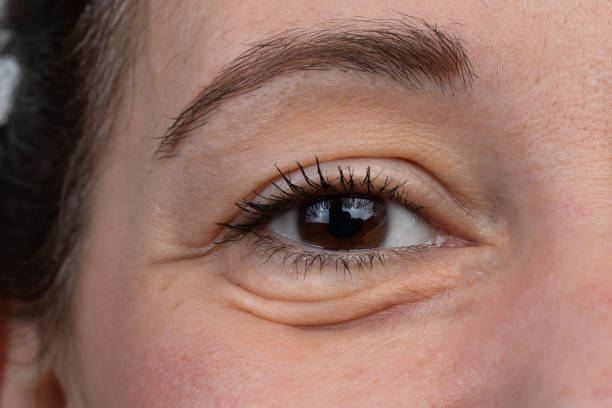 Under-Eye Rejuvenation