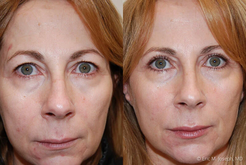 Upper Blepharoplasty